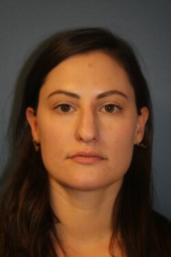 before rhinoplasty