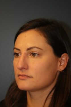 before rhinoplasty