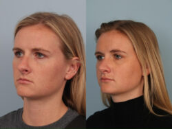 before and after rhinoplasty