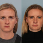 rhinoplasty-merged