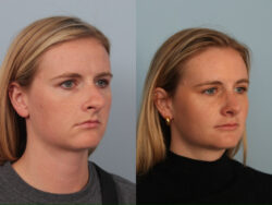 before and after rhinoplasty
