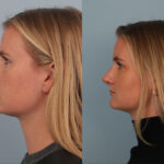 rhinoplasty-merged