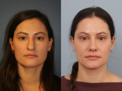 before and after rhinoplasty
