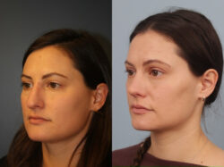 before and after rhinoplasty