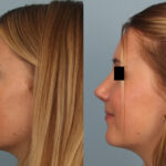 FacesFirst-Gallery-Rhinoplasty-136-Left
