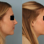 FacesFirst-Gallery-Rhinoplasty-136-Right