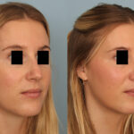 FacesFirst-Gallery-Rhinoplasty-136-Right-OBL
