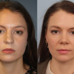 FacesFirst-Gallery-Rhinoplasty-137-Front