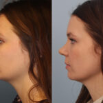 FacesFirst-Gallery-Rhinoplasty-137-Left