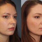 FacesFirst-Gallery-Rhinoplasty-137-Right-OBL