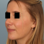 rhinoplasty-after