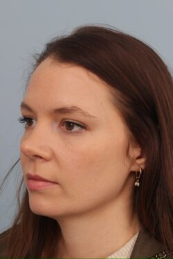 after rhinoplasty
