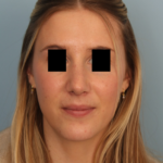 rhinoplasty-after
