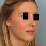 rhinoplasty-after