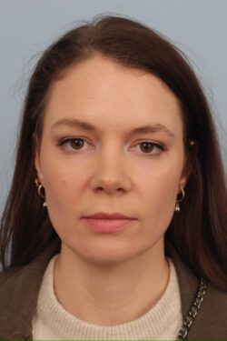 after rhinoplasty