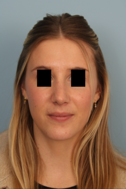 after rhinoplasty