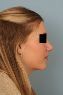 after rhinoplasty