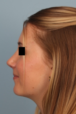 after rhinoplasty