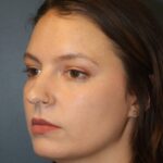 rhinoplasty-before