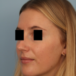 rhinoplasty-before