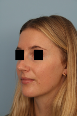 before rhinoplasty