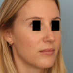 rhinoplasty-before