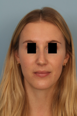 before rhinoplasty