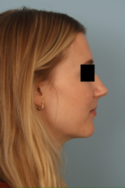 before rhinoplasty