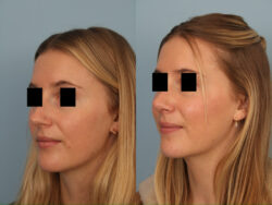 before and after rhinoplasty