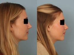 before and after rhinoplasty