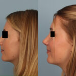 rhinoplasty-merged
