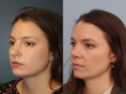 before and after rhinoplasty