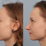 FacesFirst-Gallery-Rhinoplasty-138-Left