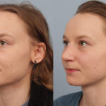 FacesFirst-Gallery-Rhinoplasty-138-Left-OBL