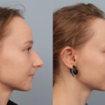 FacesFirst-Gallery-Rhinoplasty-138-Right