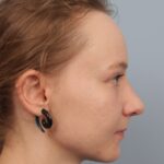 rhinoplasty-after