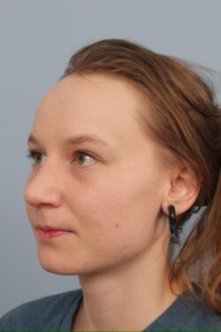 after rhinoplasty