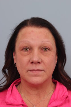 after rhinoplasty