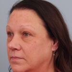 rhinoplasty-after