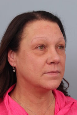 after rhinoplasty