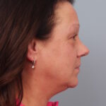 rhinoplasty-after