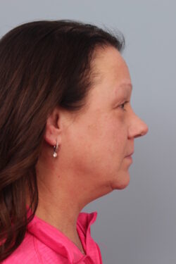 after rhinoplasty