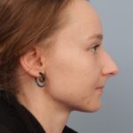 rhinoplasty-before