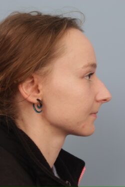 before rhinoplasty