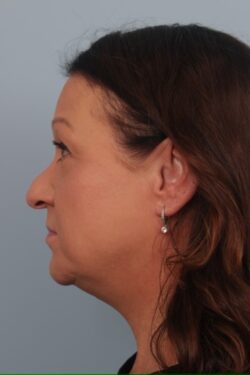 before rhinoplasty