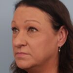 rhinoplasty-before