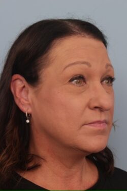 before rhinoplasty
