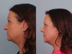 before and after rhinoplasty