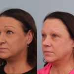 rhinoplasty-merged