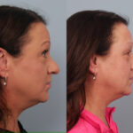 rhinoplasty-merged